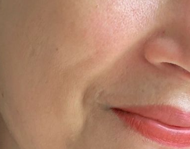 After skin improvement