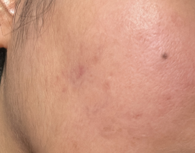 After skin improvement