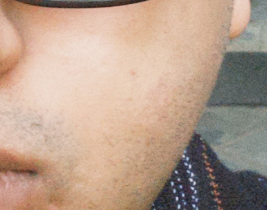 After skin improvement