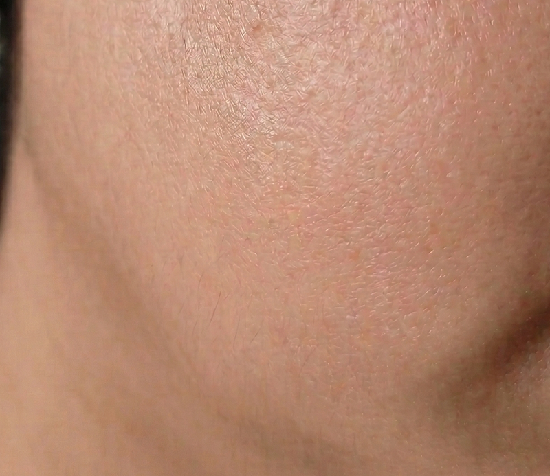 After skin improvement